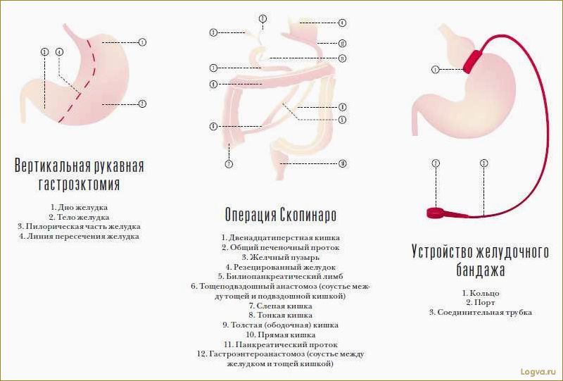 Как уменьшить размеры желудка без хирургического вмешательства и предотвратить неприятные ощущения?