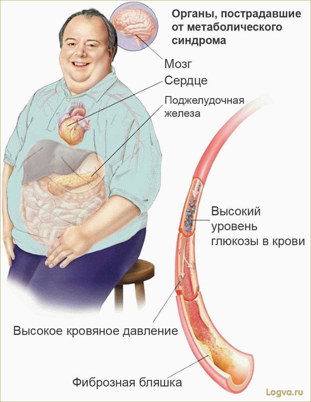 Метаболический синдром. От переедания — к сердечным заболеваниям