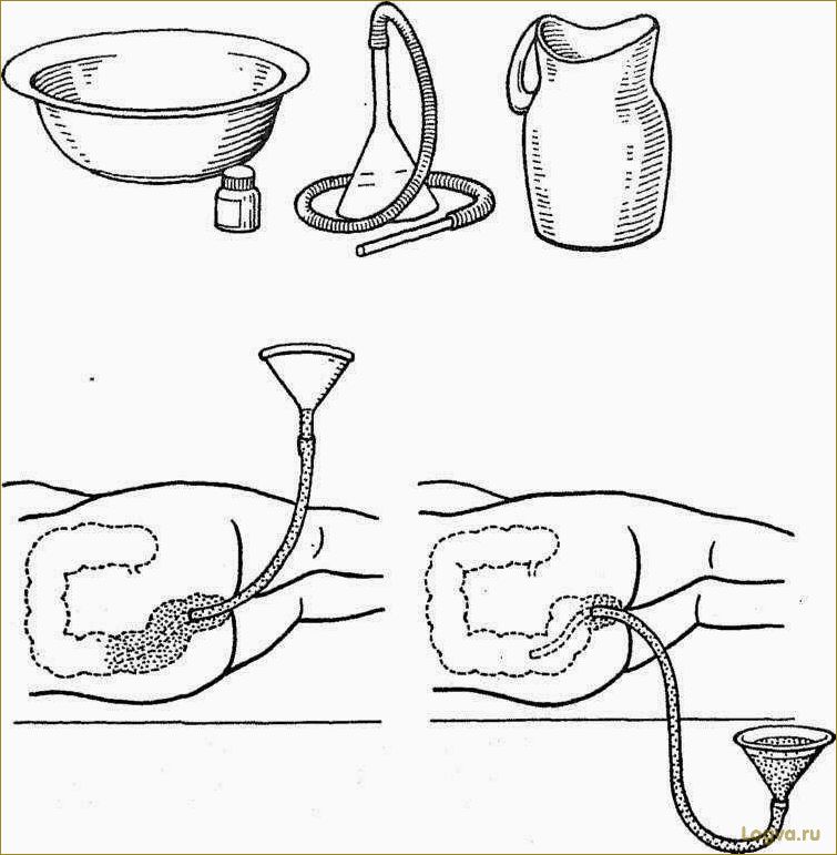 Клизмы для кишечника: как избежать вреда здоровью