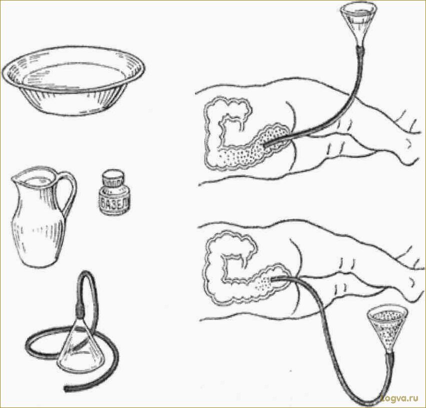 Клизмы для кишечника: как избежать вреда здоровью