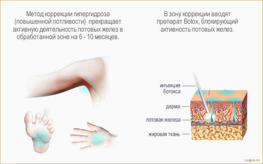 Инъекции от потливости и борьба с гипергидрозом