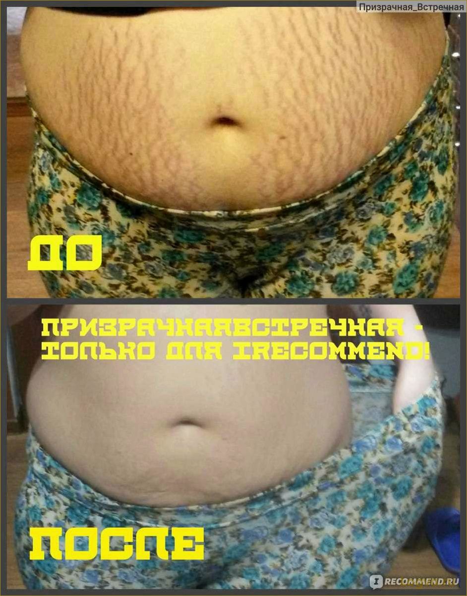 (мумиё, растяжек, эффективное, средство, кожи) Мумиё от растяжек: эффективное средство для кожи