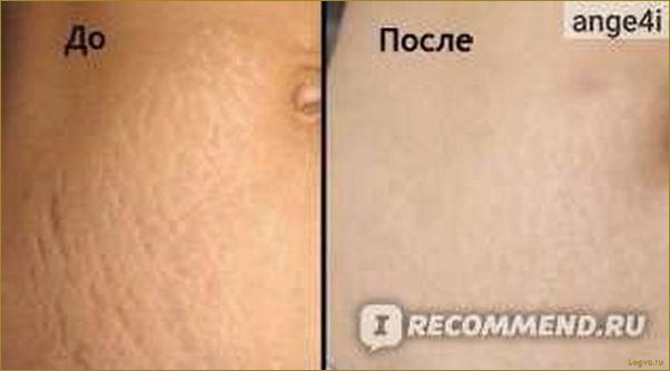 (мумиё, растяжек, эффективное, средство, кожи) Мумиё от растяжек: эффективное средство для кожи