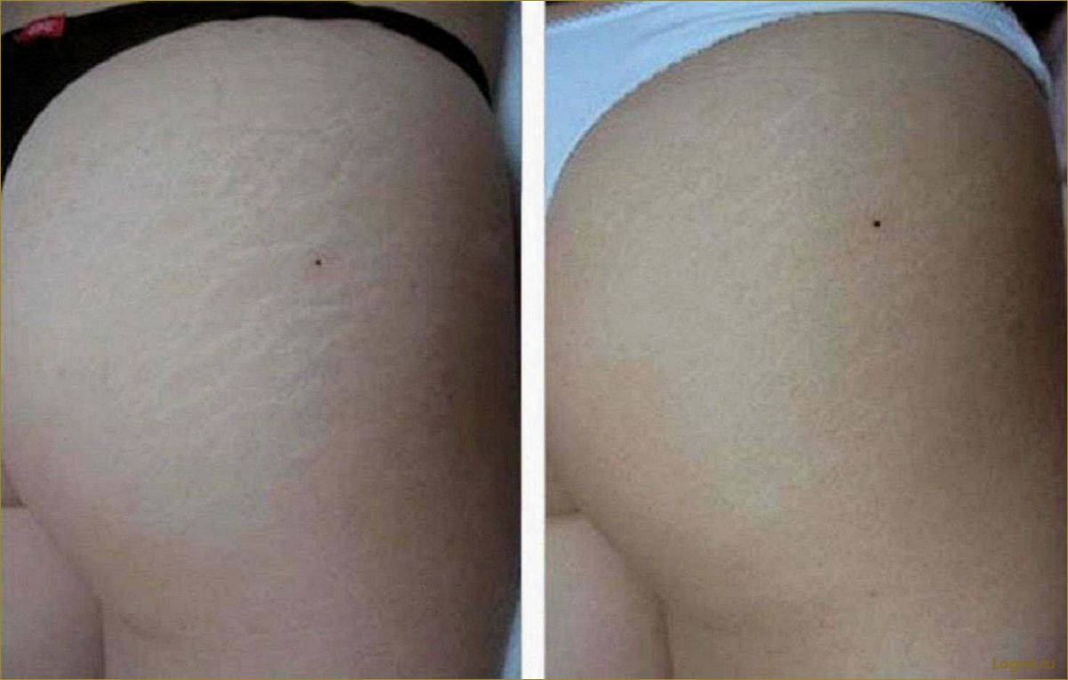 (растяжки, коже, эффективные, способы, борьбы) Растяжки на коже: эффективные способы борьбы