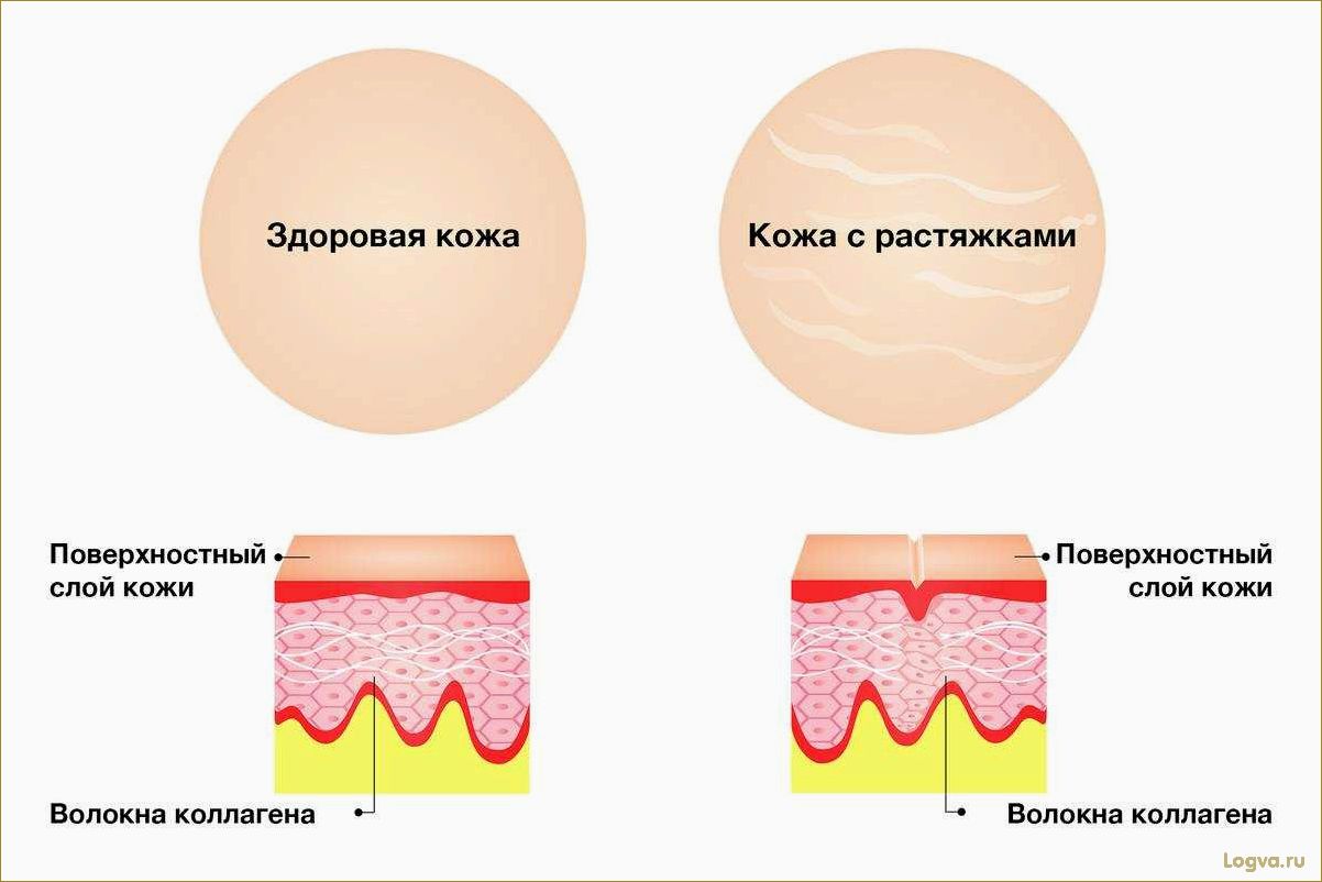 (растяжки, коже, эффективные, способы, борьбы) Растяжки на коже: эффективные способы борьбы