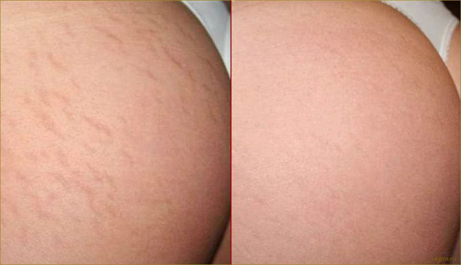 (растяжки, коже, эффективные, способы, борьбы) Растяжки на коже: эффективные способы борьбы