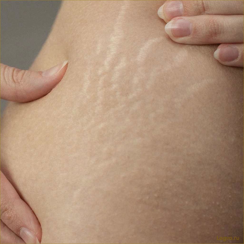 (растяжки, коже, эффективные, способы, борьбы) Растяжки на коже: эффективные способы борьбы
