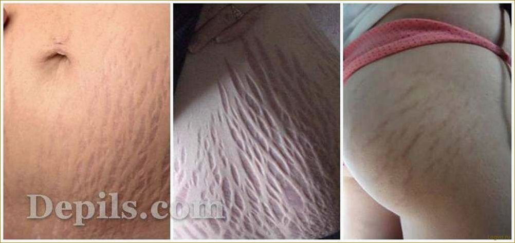 (растяжки, коже, эффективные, способы, борьбы) Растяжки на коже: эффективные способы борьбы