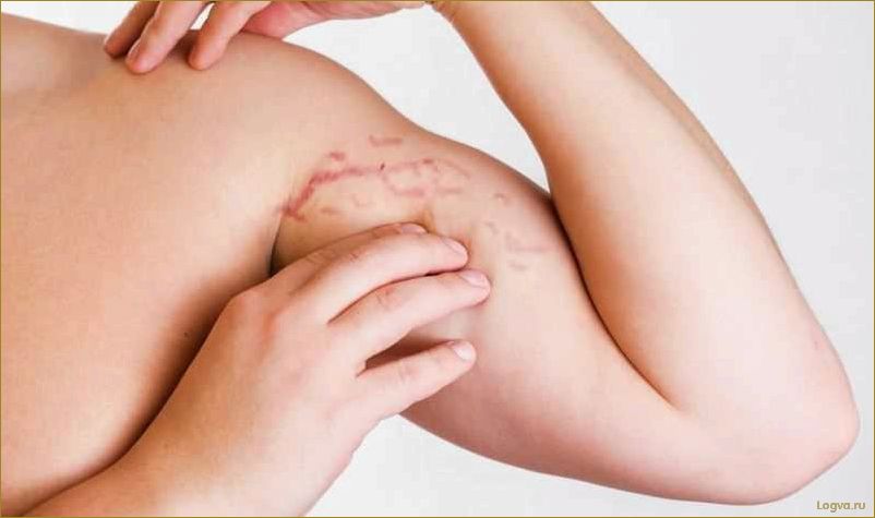 (растяжки, коже, эффективные, способы, борьбы) Растяжки на коже: эффективные способы борьбы