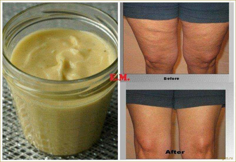 (яблочный, уксус, целлюлита) Яблочный уксус от целлюлита!